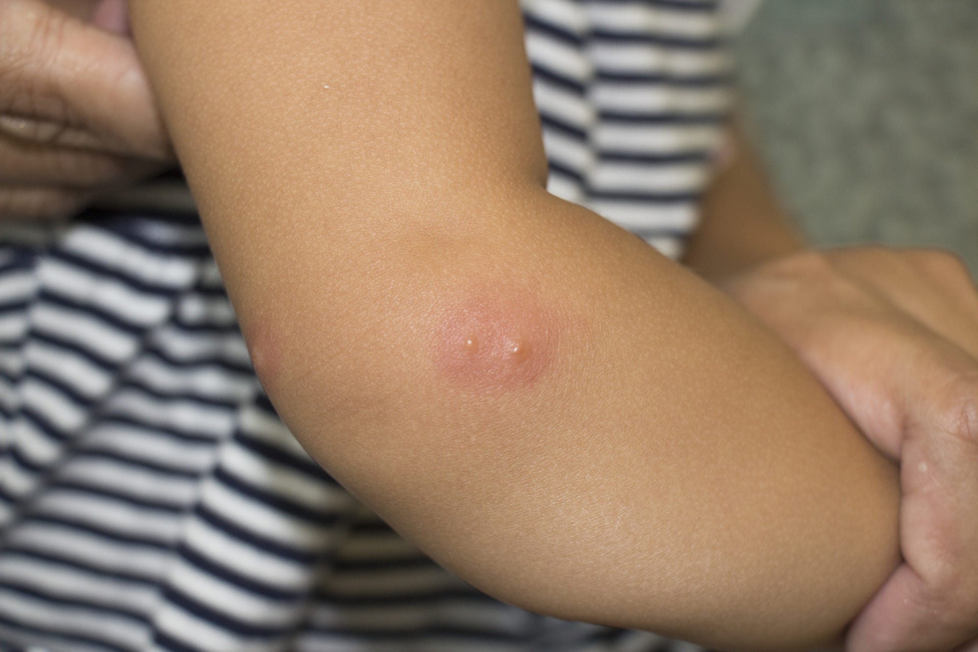 Fast Itch Relief After Bug Bites: From Everyday Home Remedies to Smart Outdoor First-Aid Tips